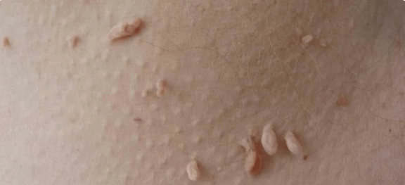 Metoda prenosa HPV