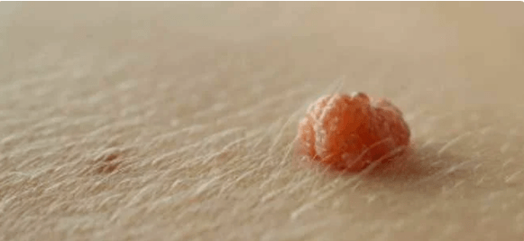 Virus papiloma