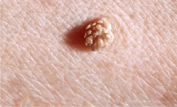 papiloma