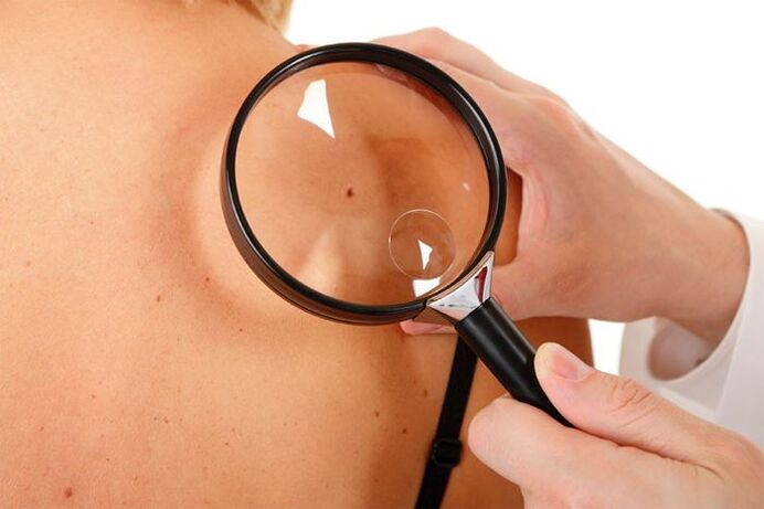 Pregled pacienta s HPV