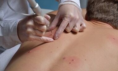 Načini odstranjevanja papiloma