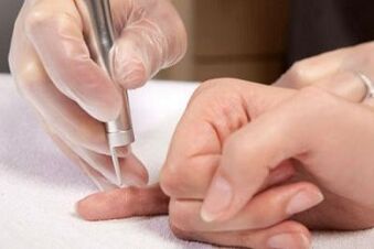 kako se znebiti papiloma na telesu