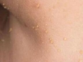 vzroki za pojav papiloma na telesu