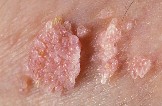 Papiloma je benigna tumorska tvorba kože in sluznice bradavičaste narave