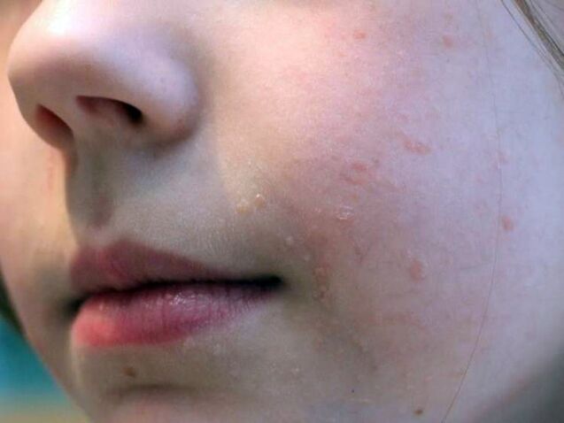 Ravne bradavice na obrazu se najpogosteje pojavijo v adolescenci